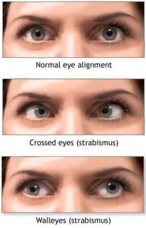 Strabismus