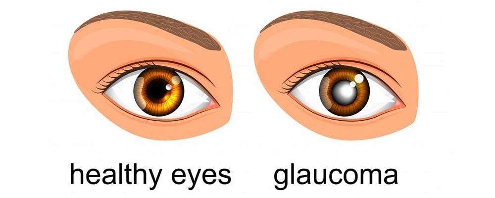 Symptoms of Glaucoma