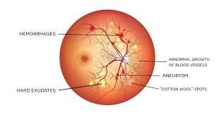 Am I at risk of having Diabetic retinopathy ?