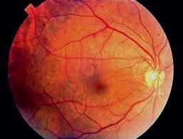 Diabetic retinopathy