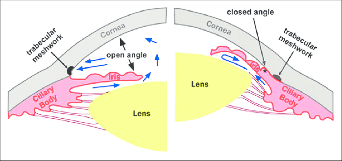Open-Angle