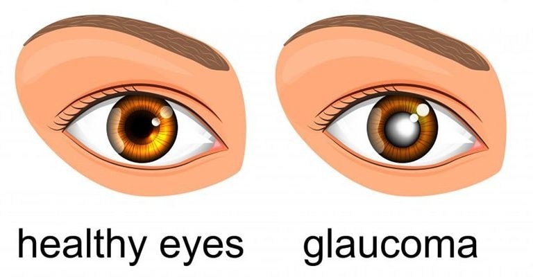 Symptoms of Glaucoma  