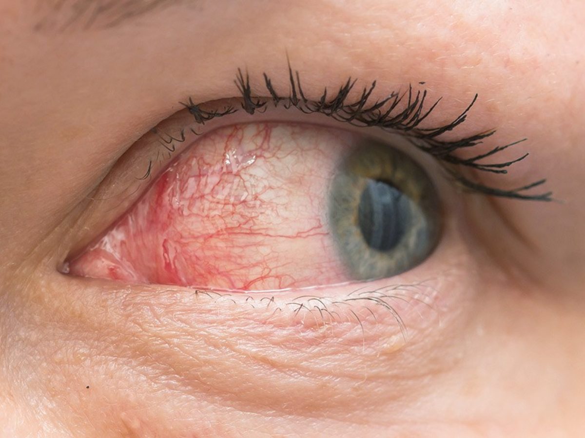 الوقاية من احمرار العيون عند الأطفال - صحتك