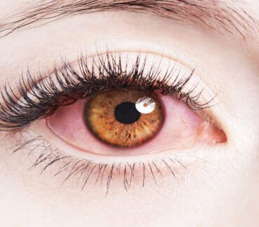ما هو التهاب جفن العين وكيفية علاجه؟