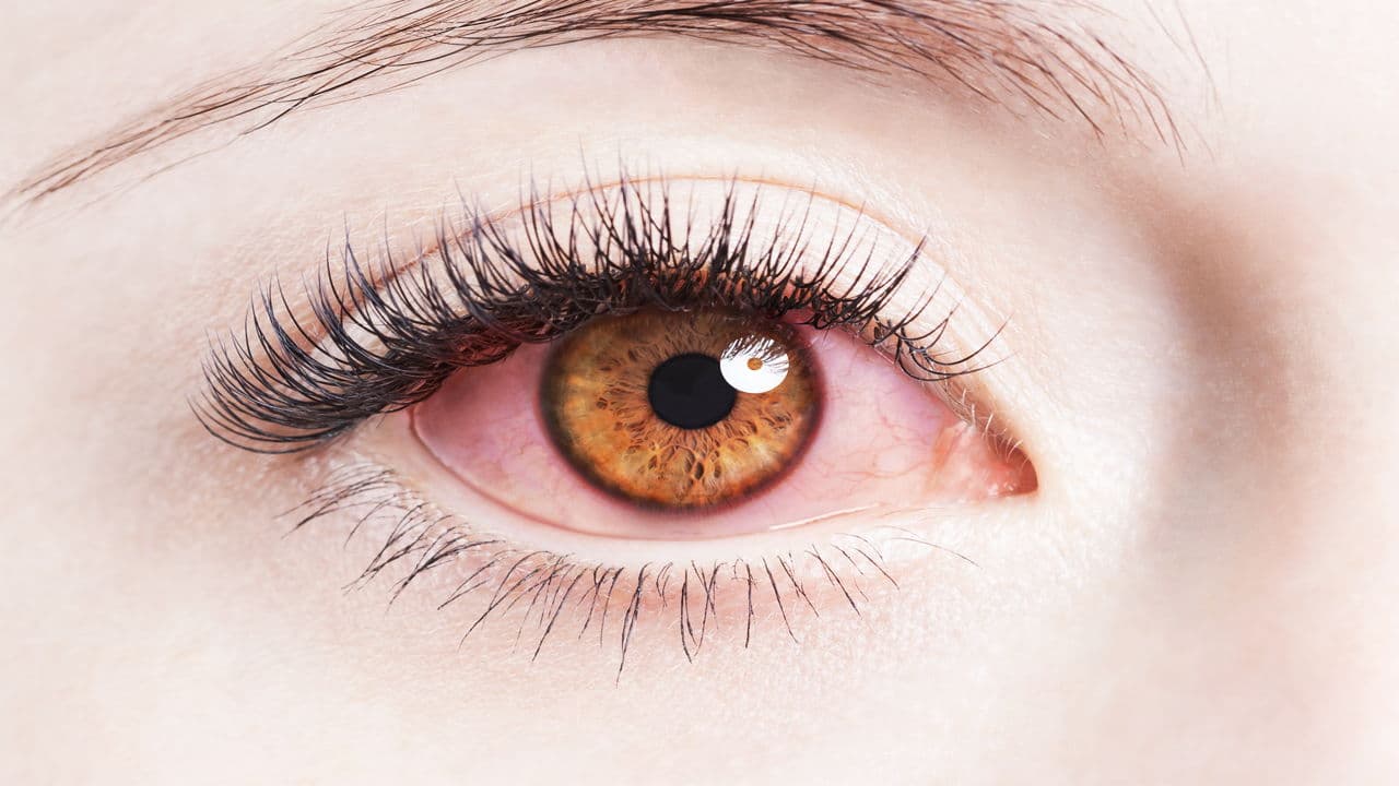 ما هو التهاب جفن العين وكيفية علاجه؟