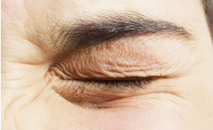 How is eyelid twitch treated?