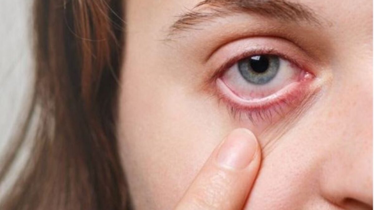 Eye Allergy Itchy Eyes Symptoms, Causes and Home Remedies for Treatment -  Royal Spanish Center