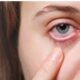 Eye Allergy - Itchy Eyes Symptoms, Causes and Home Remedies for Treatment