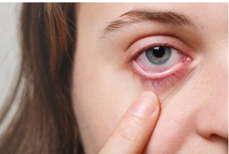Eye Allergy - Itchy Eyes Symptoms, Causes and Home Remedies for Treatment