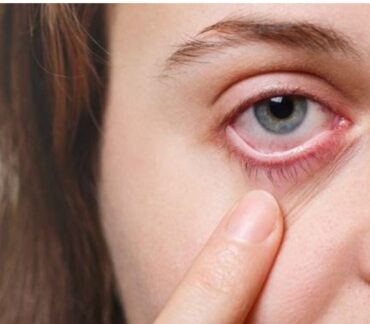 حساسية العين أعراض وأسباب الإصابة بها وأهم طرق الوقاية منها