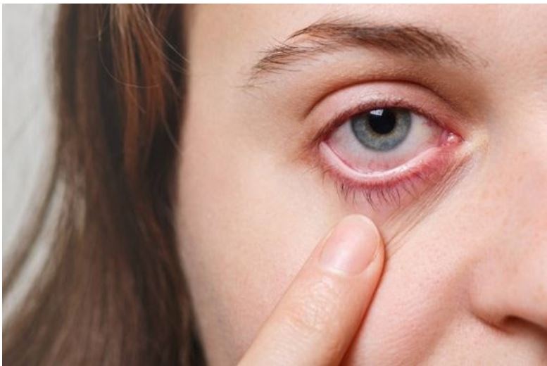 حساسية العين أعراض وأسباب الإصابة بها وأهم طرق الوقاية منها