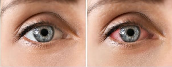 أعراض حرقان العين