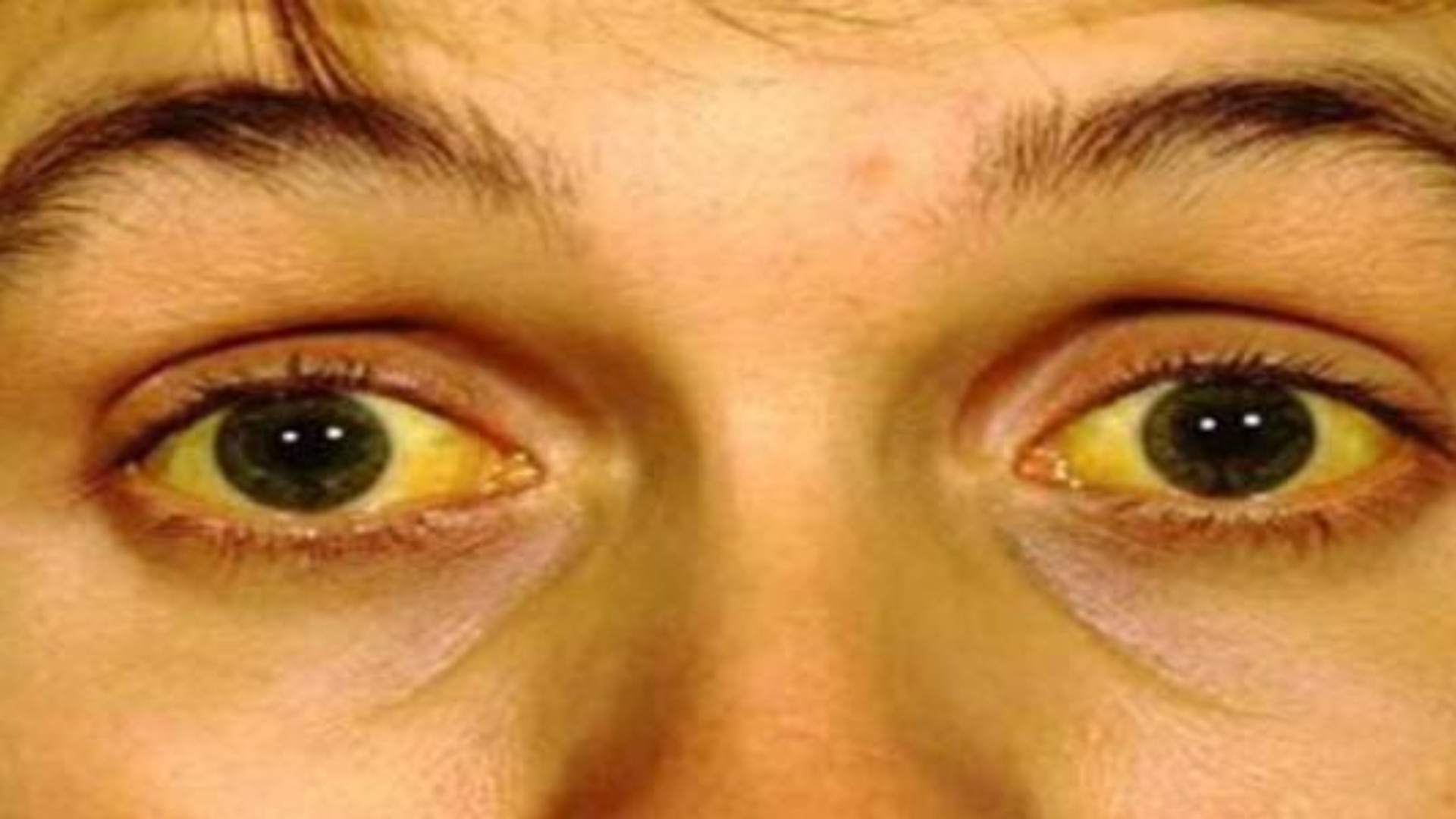 صفار العين الاسباب والعلاج المتميز