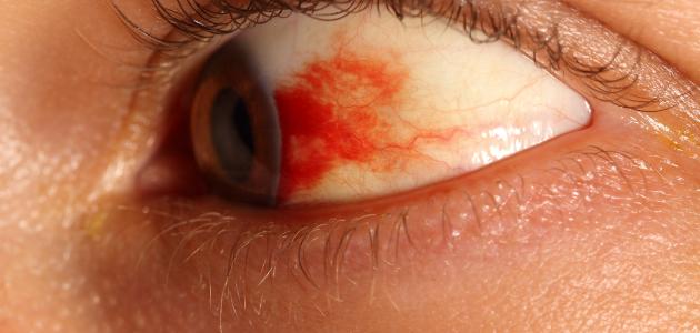 أسباب ظهور بقع الدم في العين
