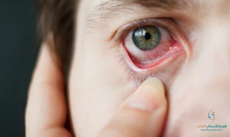 What is the cause of sudden redness in the whites of the eyes When is this considered an indication of a disease