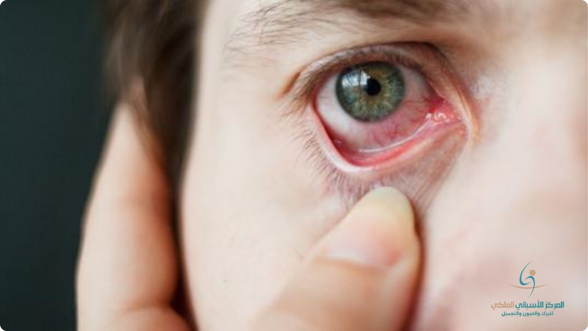 What is the cause of sudden redness in the whites of the eyes When is this considered an indication of a disease