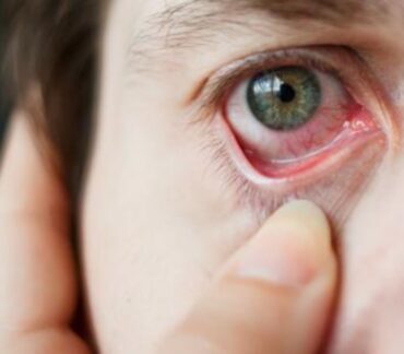 ما هو سبب الاحمرار المفاجئ في بياض العين؟ ومتى يُعتبر ذلك مؤشرًا على إصابة بمرض؟