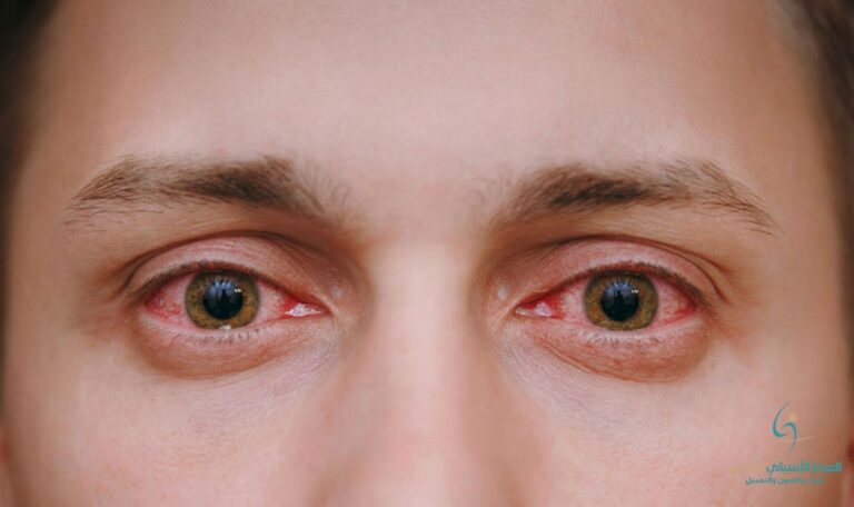 Causes of Red Eye and Its Treatment