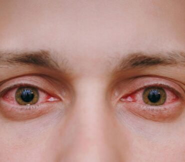 أسباب العين الحمراء وعلاجها