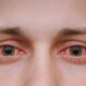 أسباب العين الحمراء وعلاجها